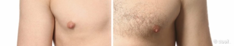 faq epilation laser bordeaux